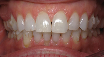 Invisalign: what are attachments and what do they look like?