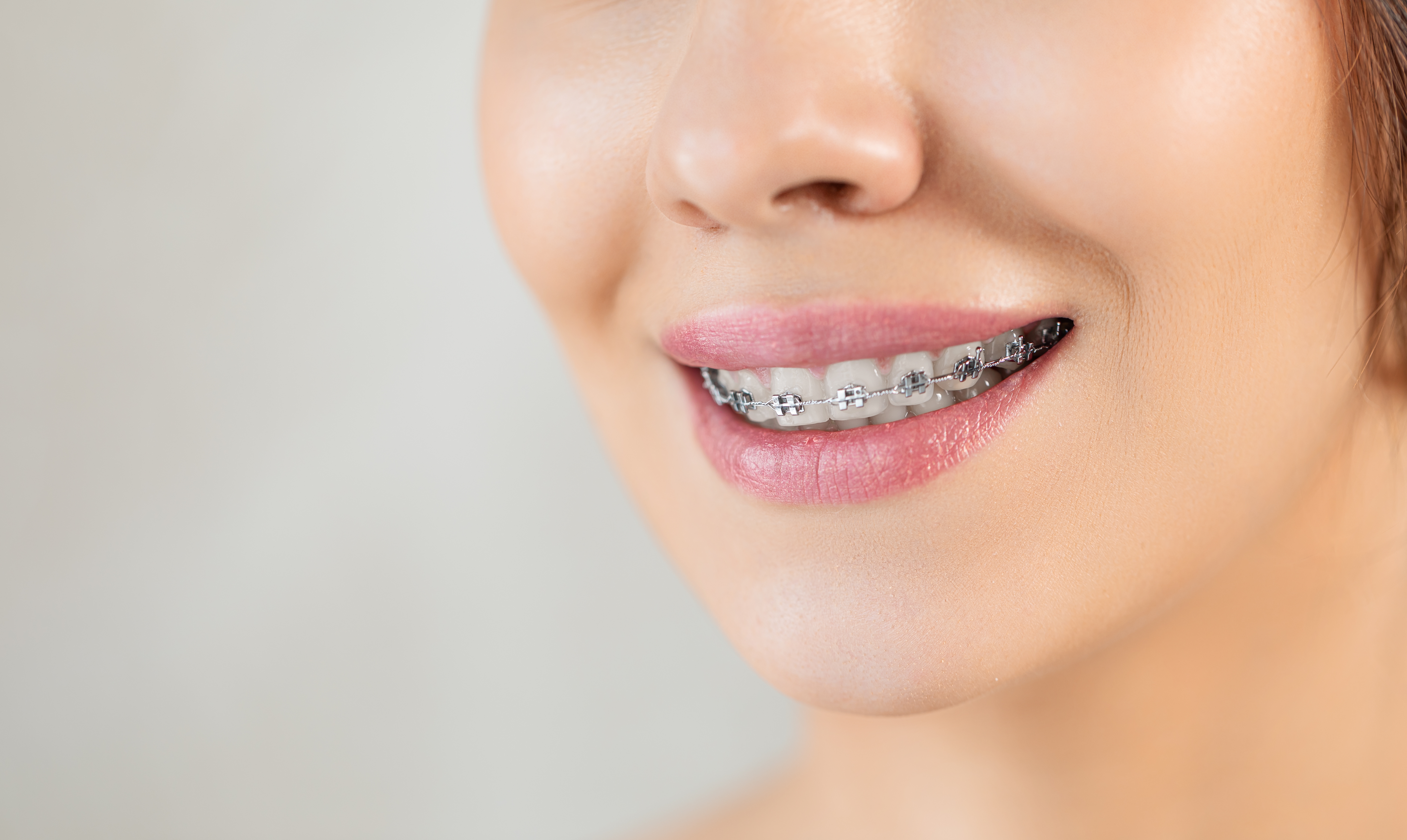 Cost of braces in Grass Valley, CA
