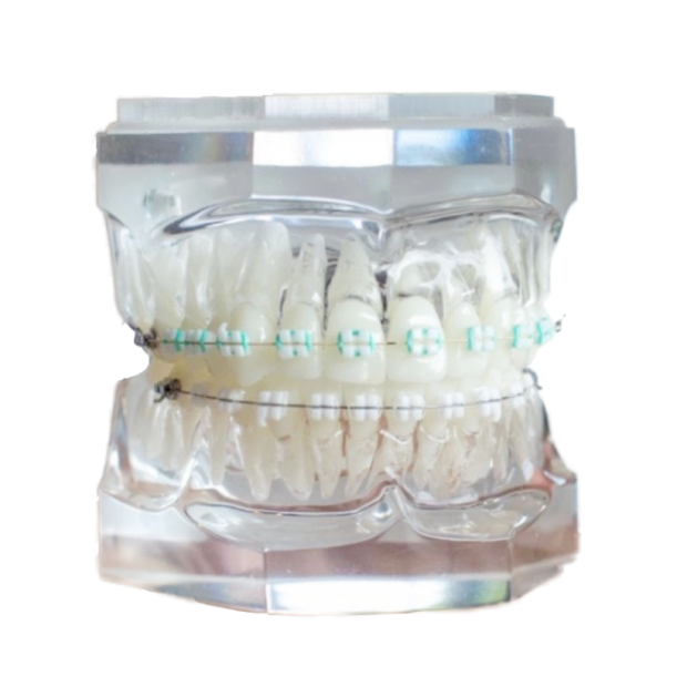 LightForce braces on model teeth